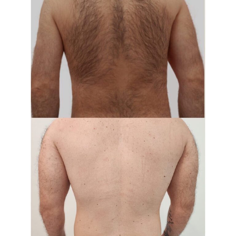 Laser Hair Removal Weston