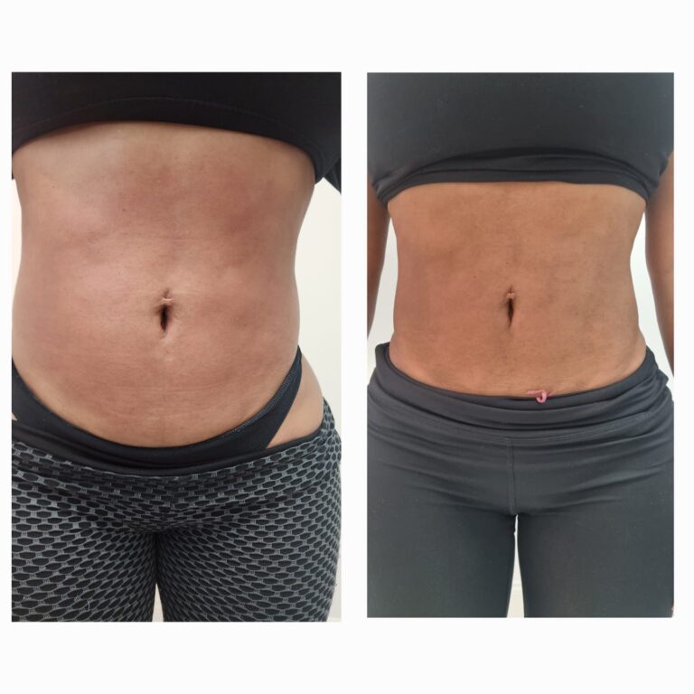 Non-invasive body contouring