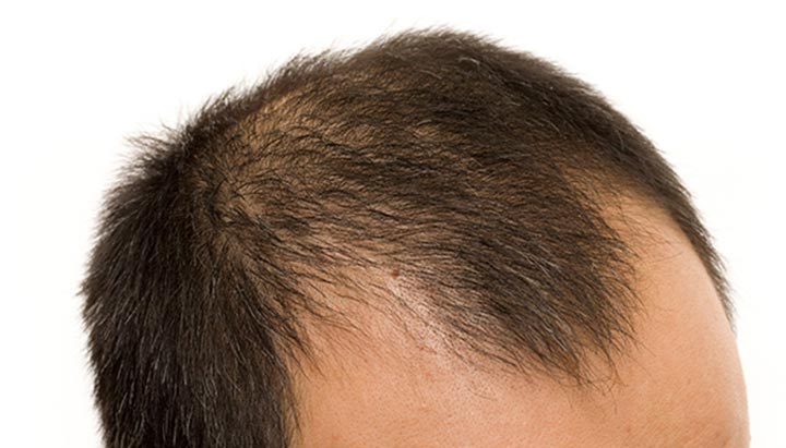 Male Pattern Baldness Treatment