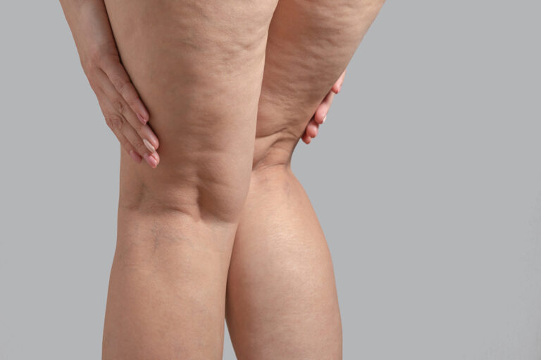 Cellulite reduction Weston