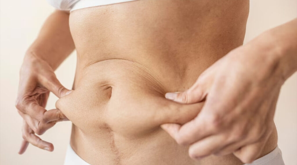 Non-surgical skin tightening treatments for loose skin after weight loss at Body Lounge Weston, including Emsculpt, Emtone, and RF therapy.