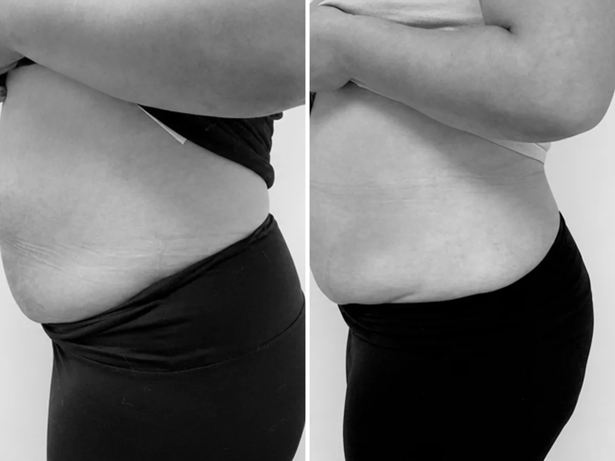 Cryoslim before and after, abdomen, side profile