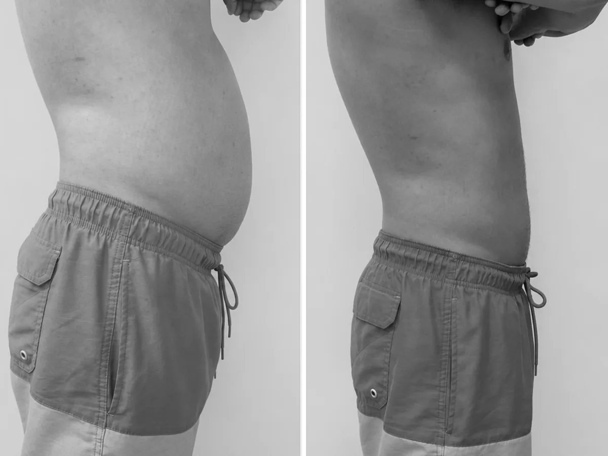 Cryoslim before and after, abdomen, side view