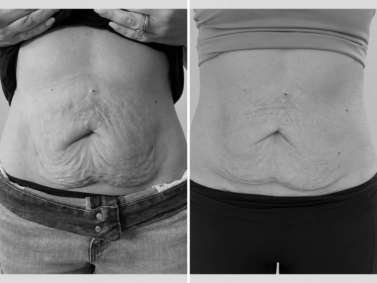 T-Shape 2 before and after, abdomen skin firmness, front view