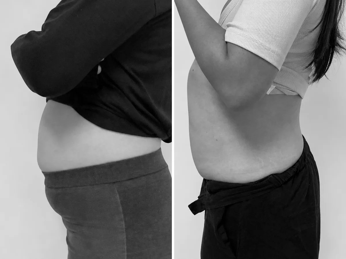T-Shape 2 before and after, abdomen, side profile