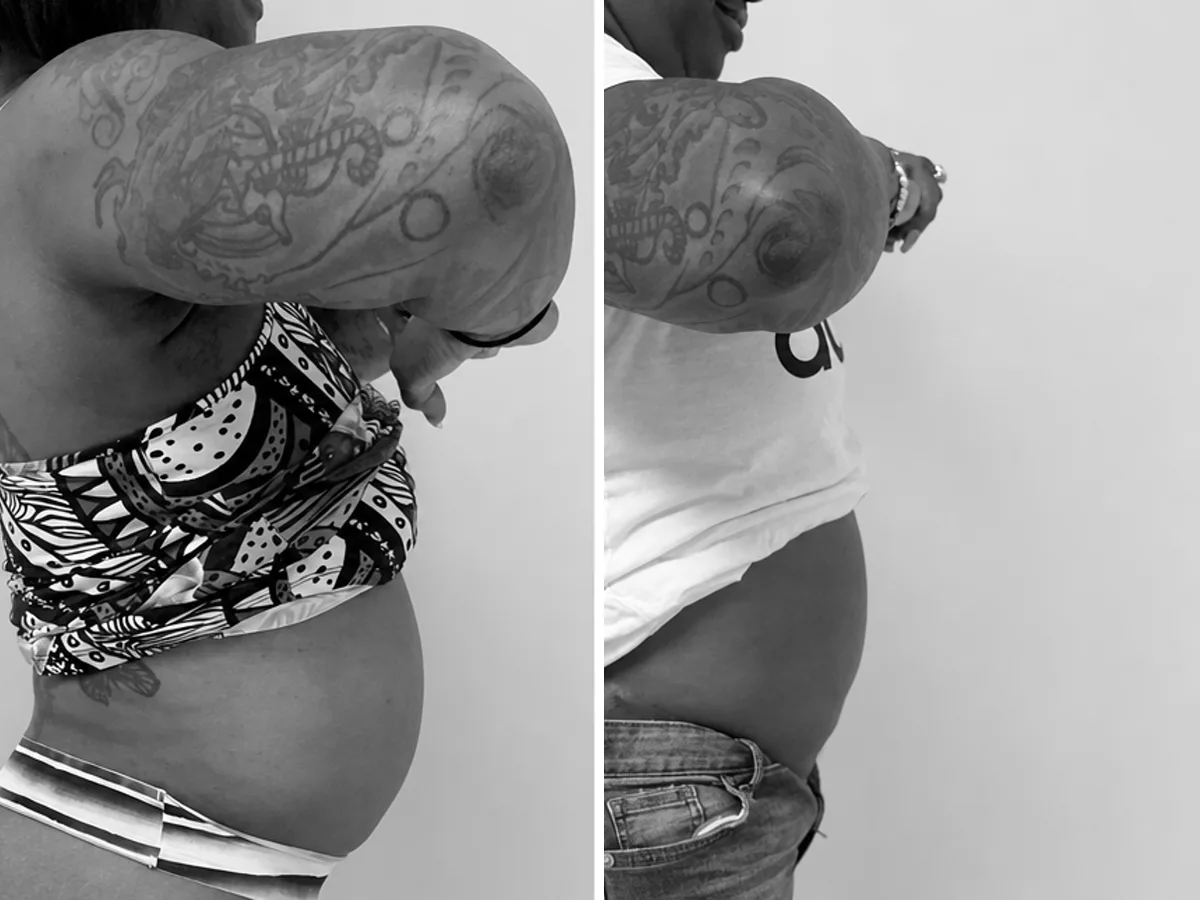 T-Shape 2 before and after, abdomen, side view